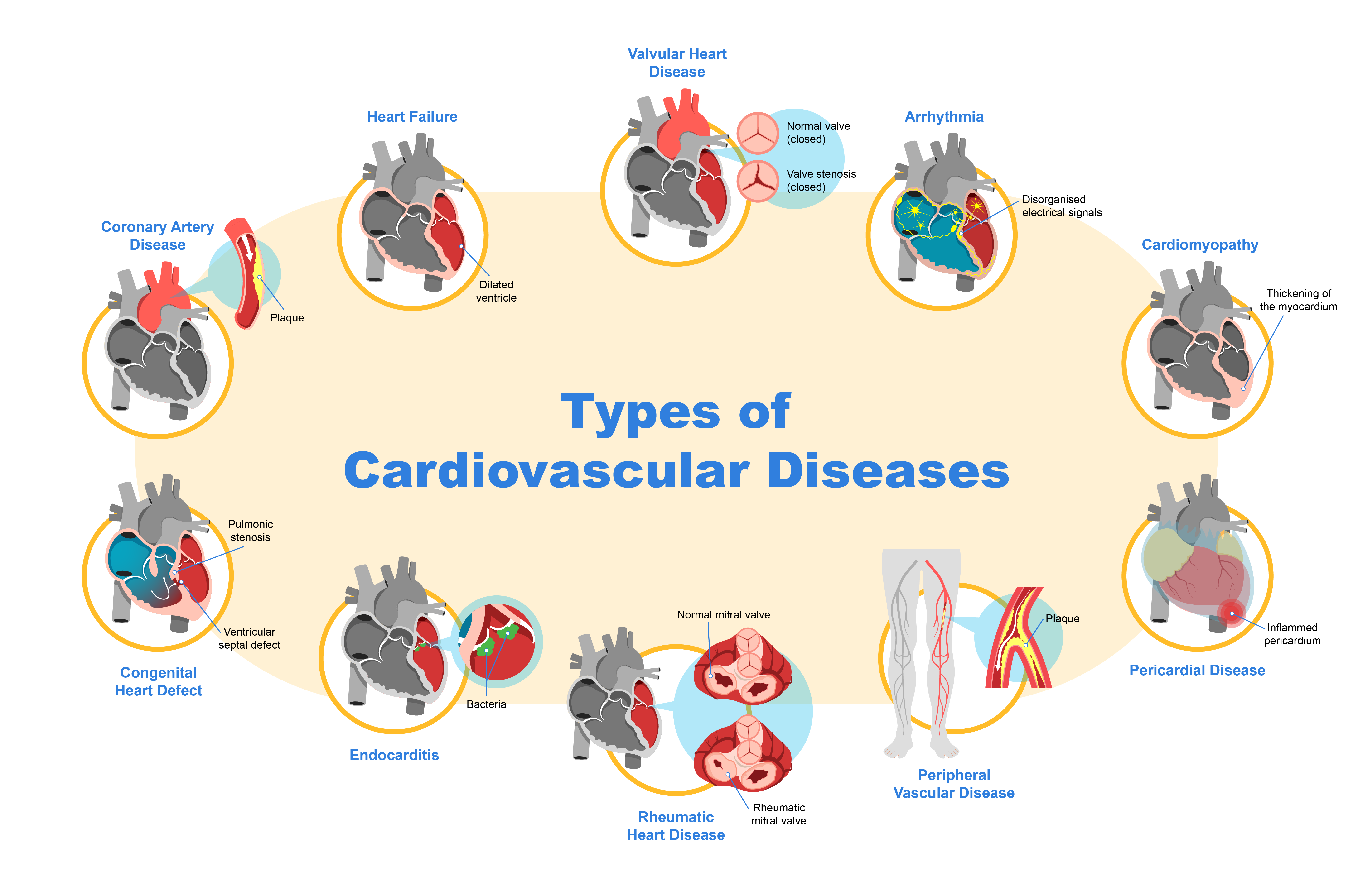 Top 10 cardiovascular conditions and diseases