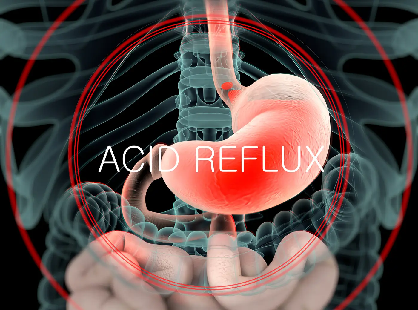 acid reflux
