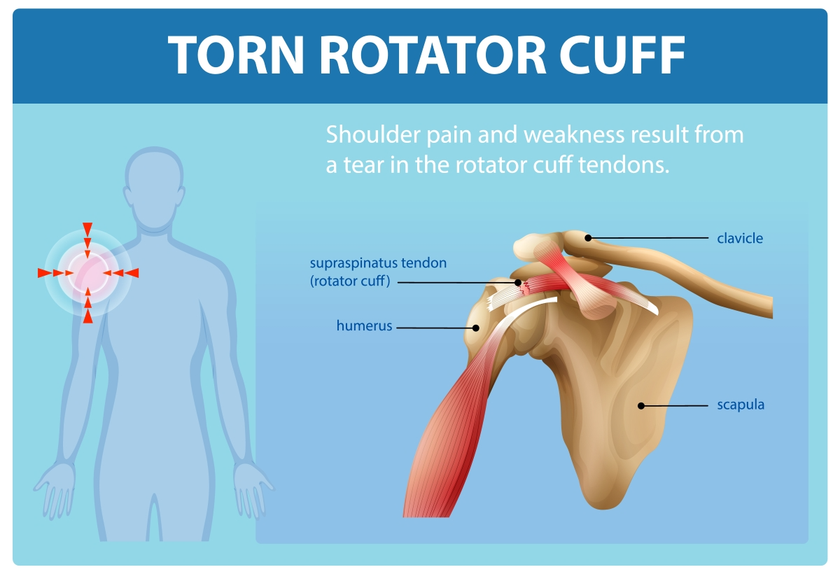 Torn rotator cuff