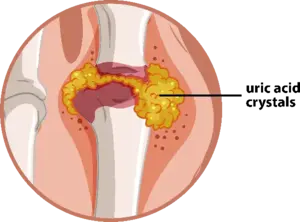 Can Gout Lead to Kidney Stone Formation2 image