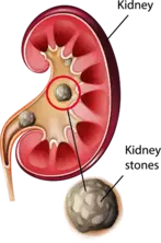 Can Gout Lead to Kidney Stone Formation3 image