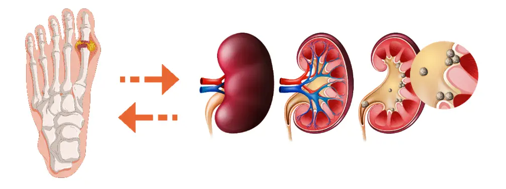 Can Gout Lead to Kidney Stone Formation4