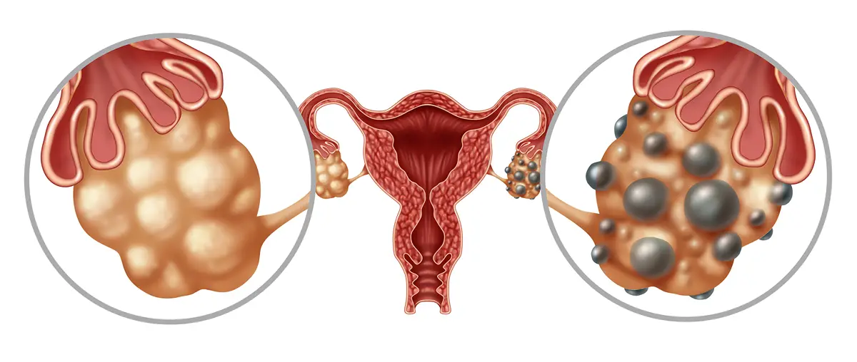 developing pcos due to elevated androgen levels