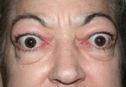 甲亢患者出现的甲状腺相关眼病。