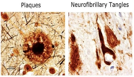 What You Need to Know About Dementia