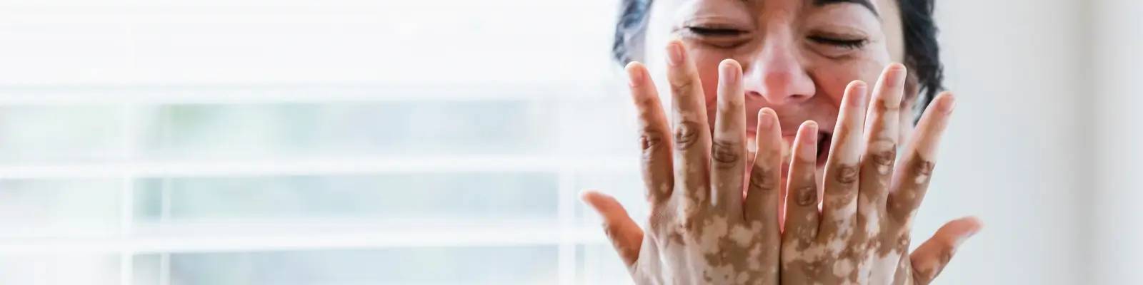 Vitiligo Banner