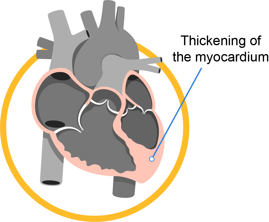 cardiomyopathy_infobanner_1