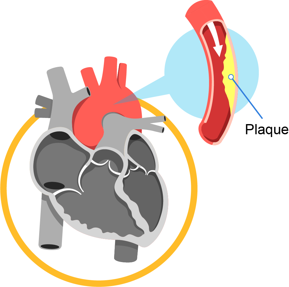 coronary