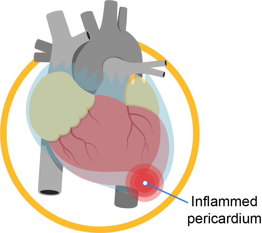 pericardial_disease_infobanner_1