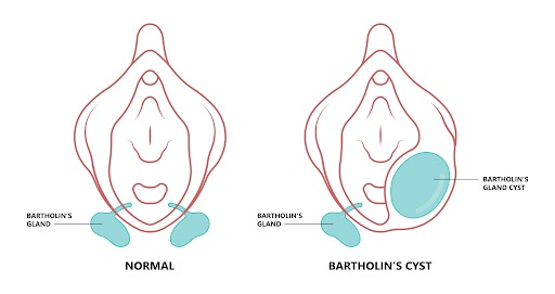 Bartholin Cyst  Pantai Hospitals