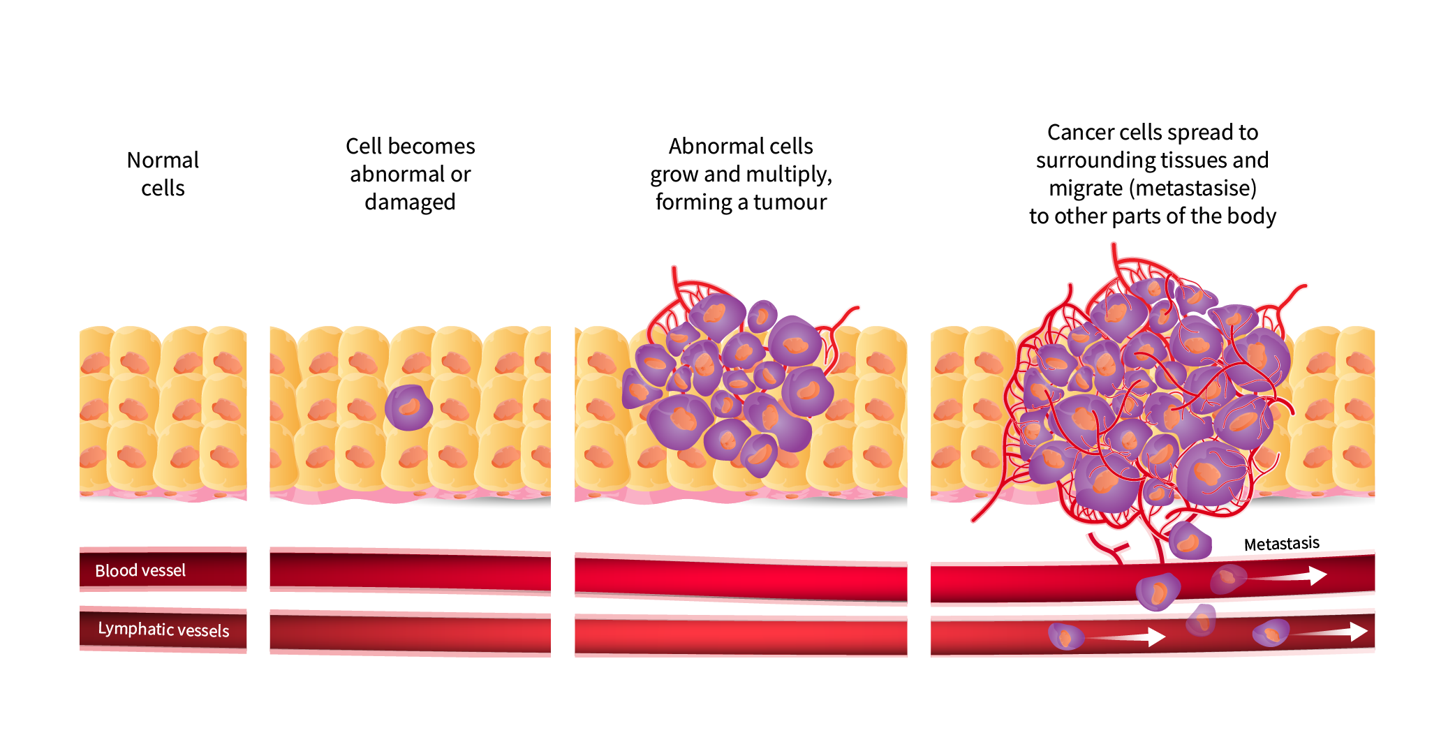 Diagram showing cancer cells spreading to surrounding tissues and migrate to other parts of the body