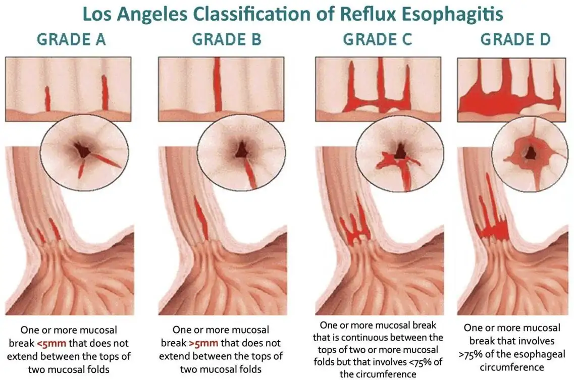 BEYOND THE BURN UNDERSTANDING ACID REFLUX-11