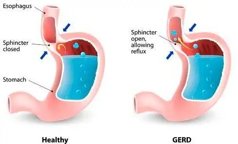 elfbar nachfüll pod läuft aus What is the relationship between vaping and GERD?