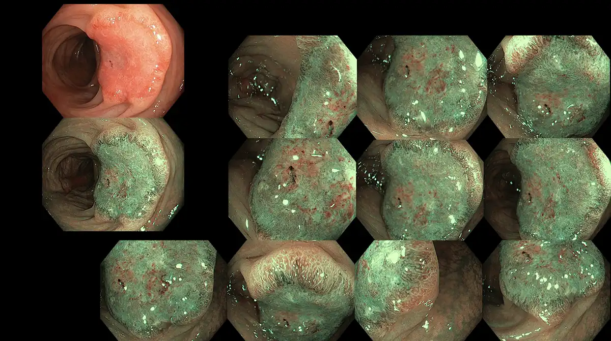 Polyp characterization of a deep invasive cancer with image-enhanced endoscopy using the Olympus narrow-band imaging technology image