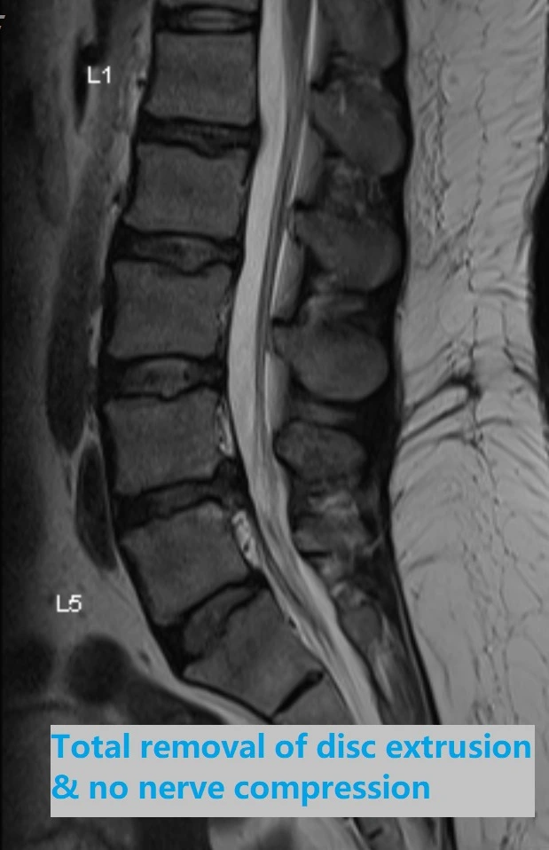 Endoscopic Spine Surgery by Dr Gee 2