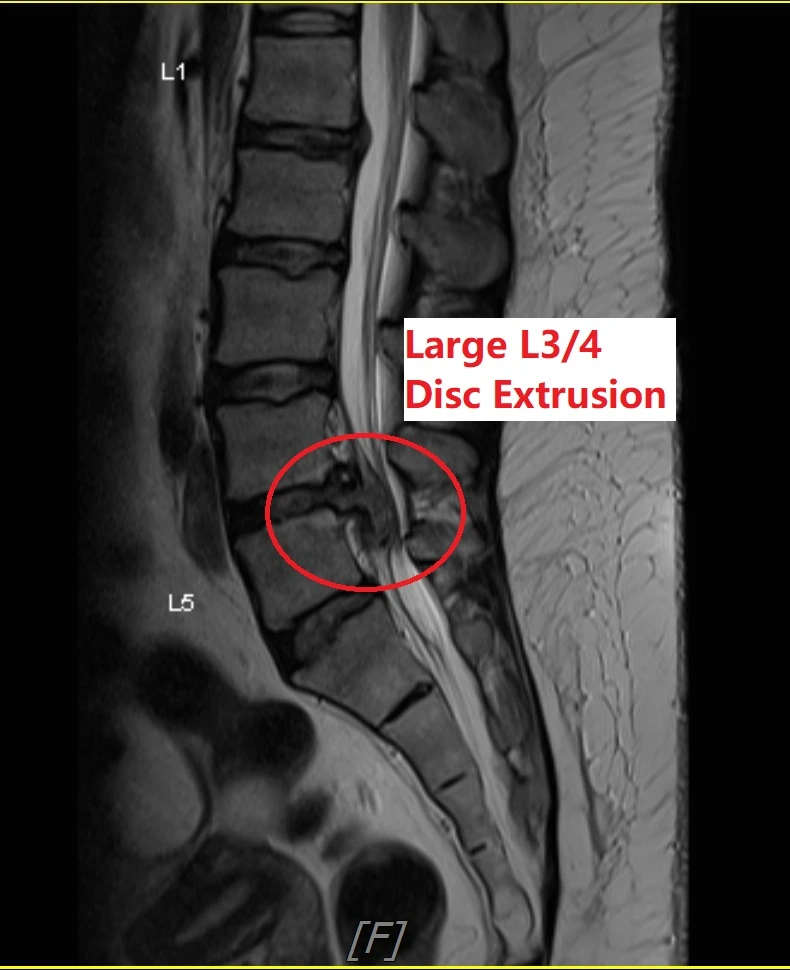 Endoscopic Spine Surgery by Dr Gee 2