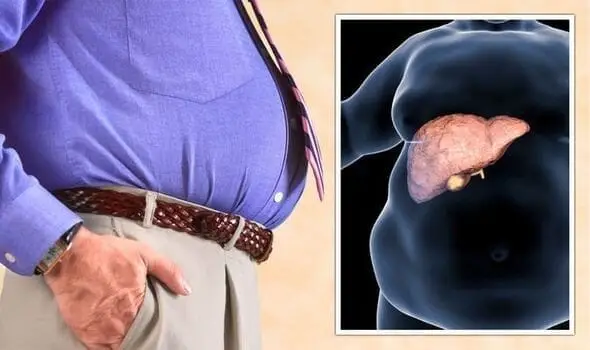 UNDERSTANDING FATTY LIVER DISEASE3