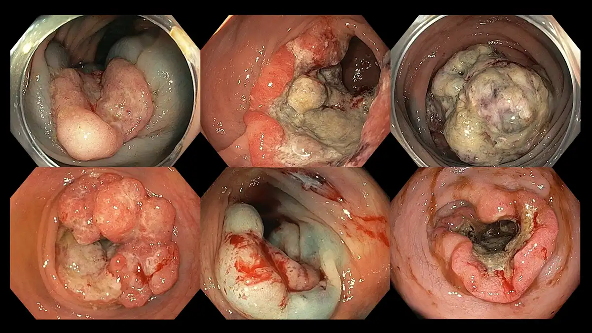 Various morphology of advanced colorectal cancer – fungating, ulcerative, and polypoidal image
